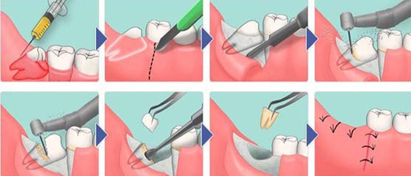 Опасные последствия удаления коренного зуба