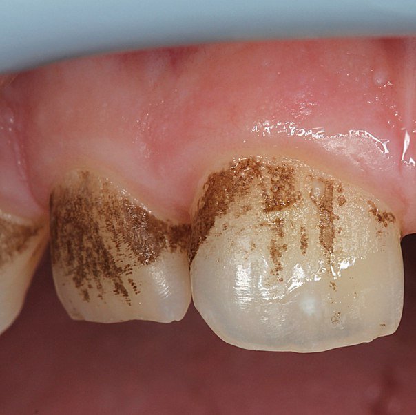 Некрасивая проблема черные зубы у детей
