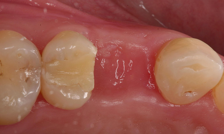 Импланты через какое время после удаления зуба их можно ставить