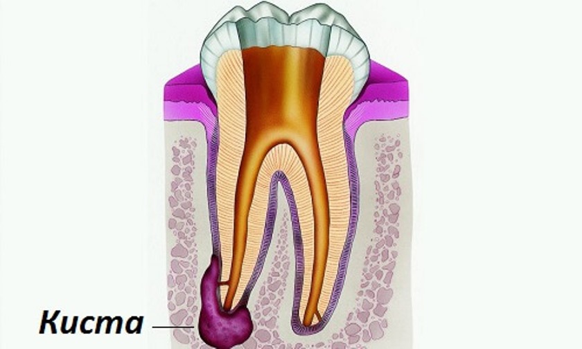Как происходит удаление кисты зуба. Больно ли это