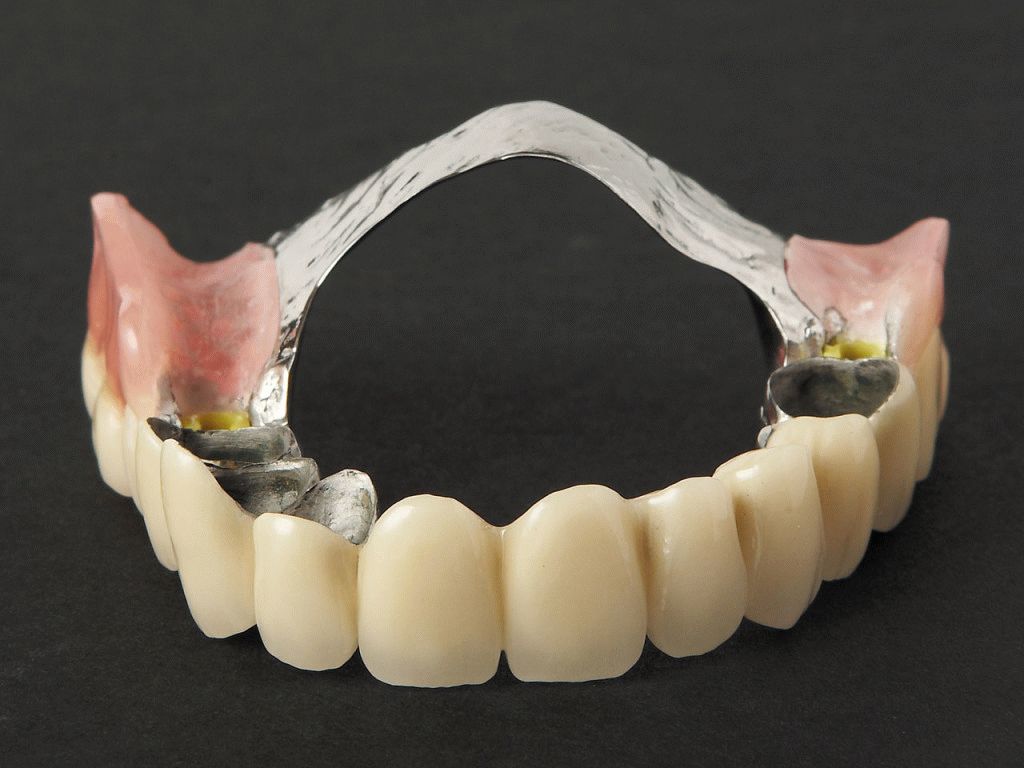 Бюгельные протезы для зубов на верхнюю челюсть фото