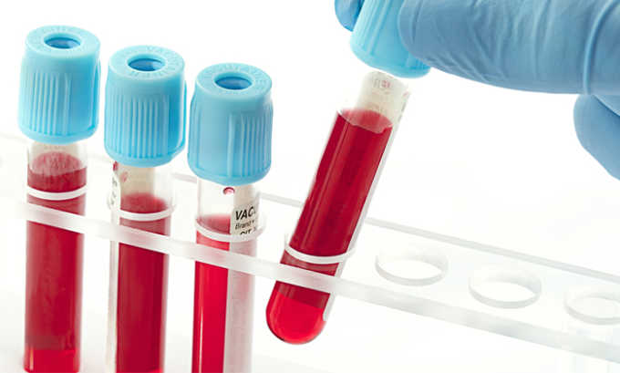 Также чтобы подтвердить заболевание нужны лабораторные результаты анализов крови
