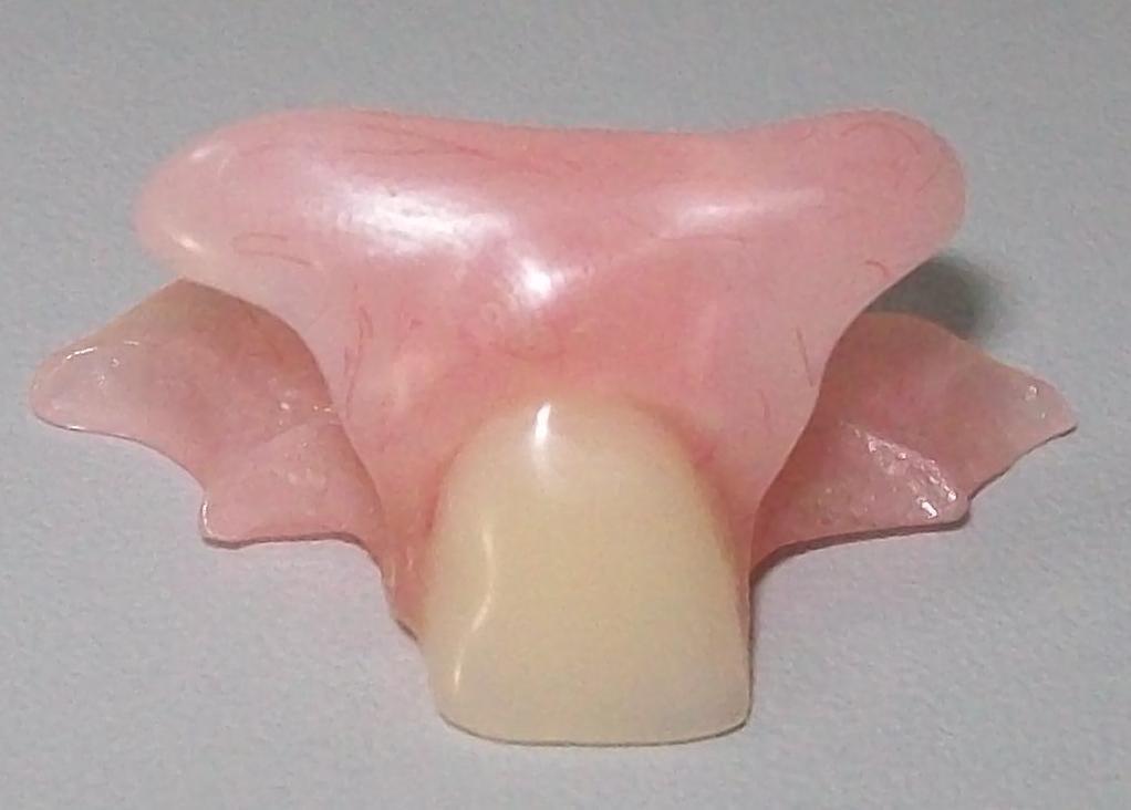 Что такое съемный зубной протез-бабочка на один зуб. Плюсы и минусы иммедиата