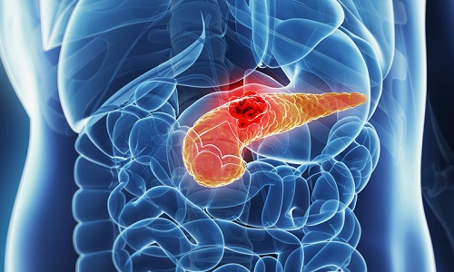Хронический рецидивирующий панкреатит - воспаление поджелудочной железы, симптомы которого периодически возникают на протяжении всей жизни человека, что способствует атрофии и некрозу тканей органа