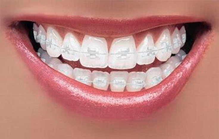 Как выбрать прозрачные брекеты на зубы? Плюсы и минусы систем из разных материалов