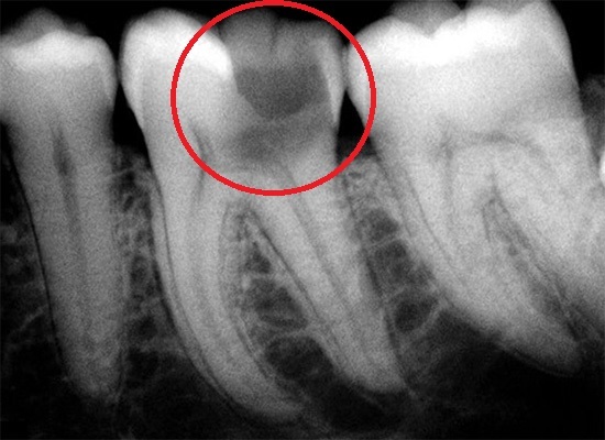 Воспаление нерва пульпит зуба, что это такое
