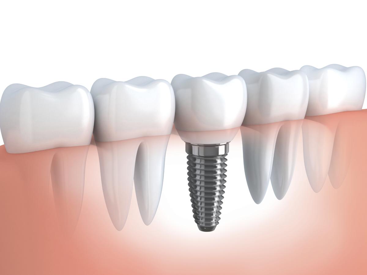 Обследования и протезирование можно ли делать МРТ с имплантами зубов. Как правильно подготовиться к операции по имплантации