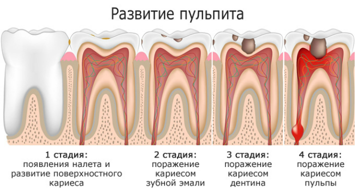 Правильное лечение пульпита молочных зубов у детей. Как не допустить ошибок