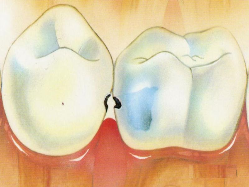 Лечение кариеса между зубами. Спасаем красоту передних зубов