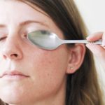 Способы устранения гематомы под глазом