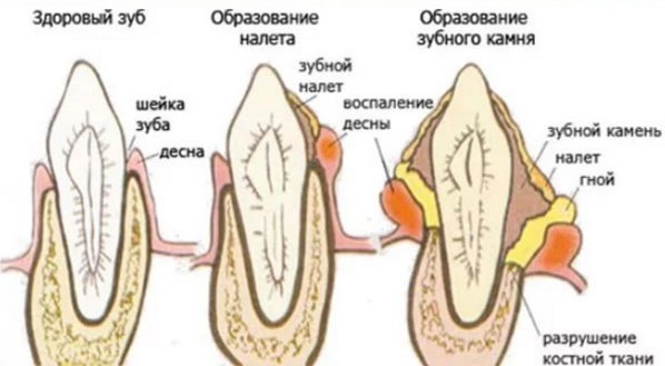 Как проходит процедура удаления зубного камня ультразвуком. Какой аппарат лишен минусов бесконтактного влияния